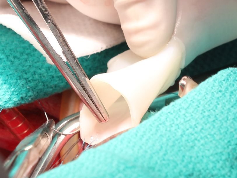 Имплантация искусственных артерий