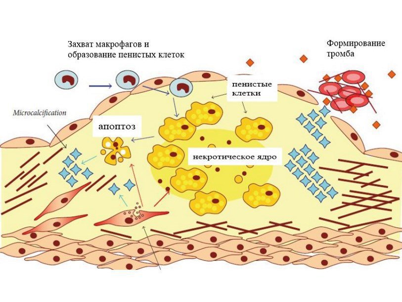 Разрастание атеросклеротической бляшки в стенке сосуда, образование пенистых клеток, их отмирание (апоптоз) и формирование некротического ядра