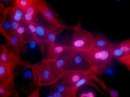 Окрашенные флуоресцентным красителем клетки рака молочной железы